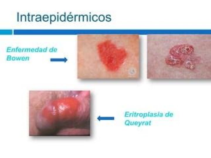 Eritroplasia de Queyrat