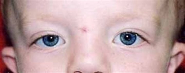 Multiple lentigines syndrome