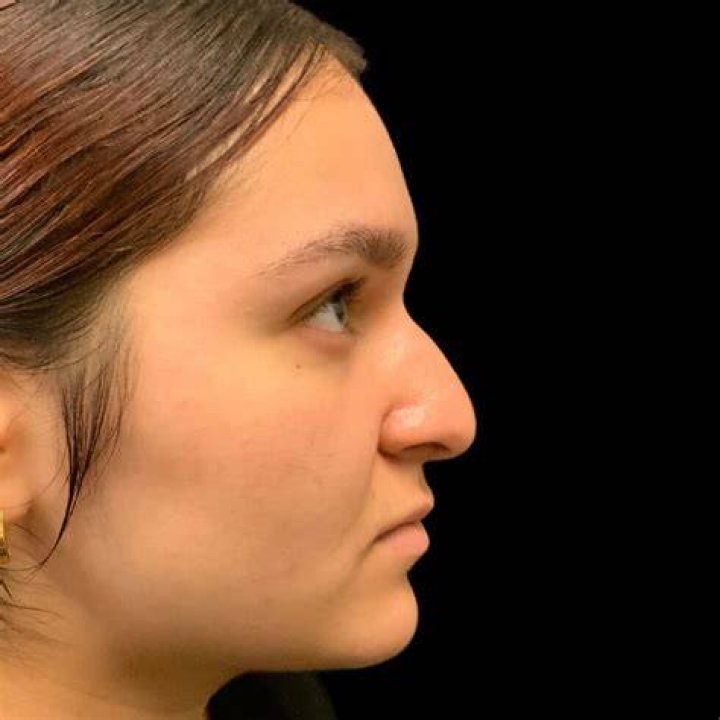 Nashville Affordable Rhinoplasty Specialists