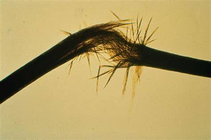 Trichorrhexis nodosa